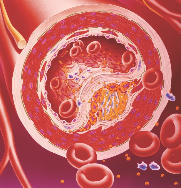 Narrowed artery due to cholesterol